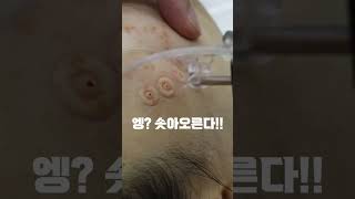 에어서브시전(Air-subcision) 파인 여드름흉터 치료 어븀에어셀 2단계