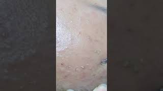 Best Satifying videos for Relaxation with Rat Tana Acne Spa =Short