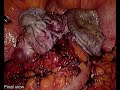 deroofing of b l endometriomas