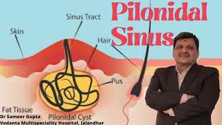 क्या पायलोनिडल साइनस (Pilonidal Sinus)एक गंभीर स्थिति है? How Serious Is a Pilonidal Sinus?