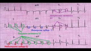 ЭКГ номер 14 - заключение, клиническая интерпретация и что делать