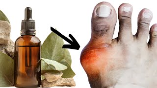 Amazing  OIL Cures GOUT! Removes Pain, Swelling, Redness...