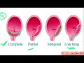 placenta mcq part 1 previousyearquestions 2025 mp mahila supervisor viralvideo old papers