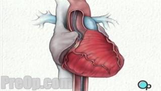 Balloon Angioplasty Coronary Angioplasty - PreOp® Patient Education Medical HD