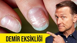 Demir eksikliğinin kritik belirtisi! Demir eksikliği neden olur? | Dr.berg Türkçe