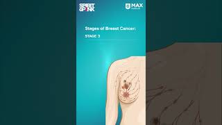 Stages of Breast Cancer