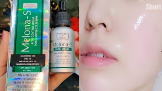 Niacinamide Serum |how to use niacinamide serum| remove acne scars and pimples |Melona s serum