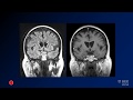 Neuroradiology board review lecture 1 case 1