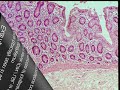 what is dysplasia pathology mini tutorial