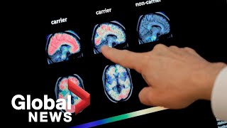 Mysterious brain disease emerges in New Brunswick: What doctors know so far