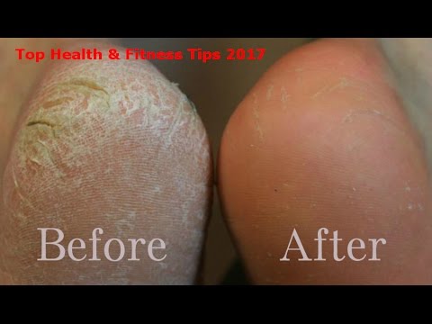 How to Get Rid of Dry or Dead Skin on Feet, Face, Lips, Hands Natural Tips How to Get Rid of Dry or Dead Skin on Feet, Face, Lips, Hands Natural Tips