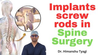 Implants (screw/rods) in Spine Surgery.