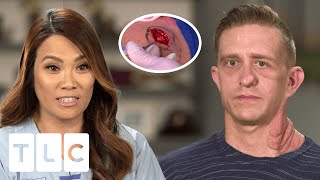Dr Lee Treats Patient Covered In Hundreds Of Tumours I Dr. Pimple Popper: Pop ups