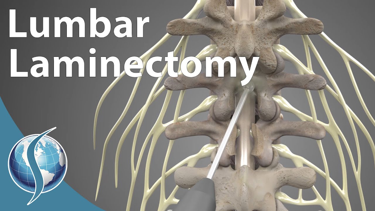 Lumbar Laminectomy - YouTube