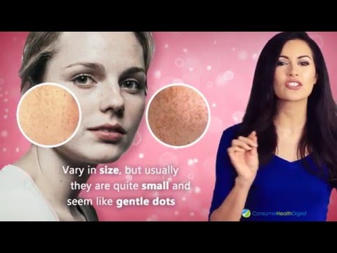 Why Do We Get Freckles and How to Treat Them? Why Do We Get Freckles and How to Treat Them?