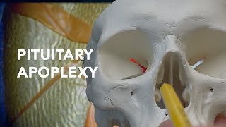 Emergency Brain Surgery for Pituitary Apoplexy