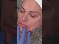 🌟 join us for the most comprehensive dermal filler training 🌟 watch this incredible video