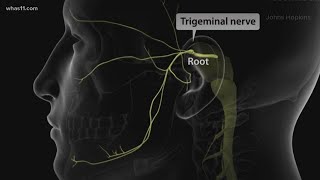 Trigeminal Neuralgia, local doctors may have found the cure