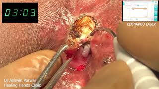 Live Laser Fissurectomy in chronic fissure | Rectal Polypectomy | Anal Stricture Surgery | Pune Goa