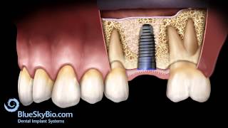 Patient Treatment Videos: Sinus Lift Internal