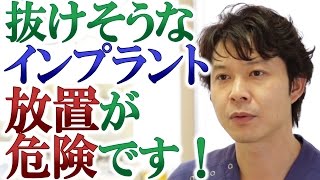 抜けそうなインプラントの放置が危険な理由とは？【千葉県千葉市の歯科】