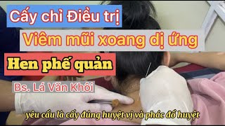 Cấy chỉ điều trị viêm mũi xoang dị ứng, hen phế quản | Bác sĩ lá Văn khôi