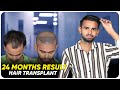 Hair Transplant in Bangalore | Best Results & Cost of Hair Transplant in Bangalore