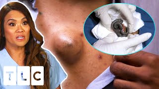 Dr Sandra Lee Removes Larry The Lump From Man’s Chest | Dr Pimple Popper | UNCENSORED | 18+