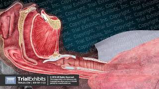 Pediatric Tracheostomy