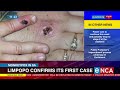 Monkeypox in SA | Limpopo confirms first case