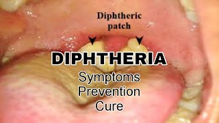 Diphtheria : Symptoms, Prevention, Cure