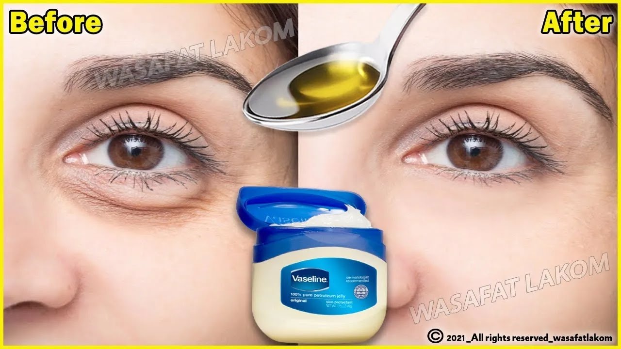 In 3 Days Remove Under Eye Bags Completely | Remove Dark Circle ...