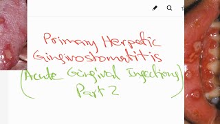 Primary Herpetic Gingivostomatitis - Acute gingival infections (part2) - Lecture