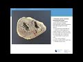 David Miranda - Heart Transplantation at the Minneapolis Heart Institute® - 4/24/2017