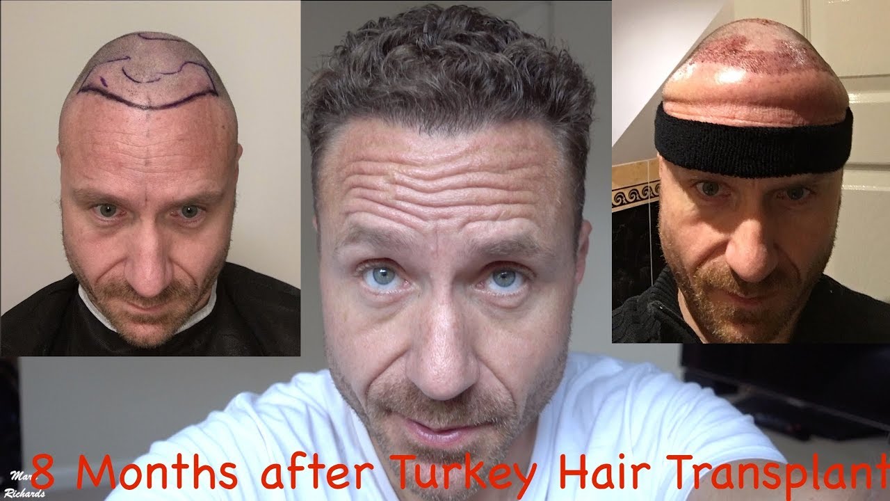 HAIR TRANSPLANT In ISTANBUL - 8 Months On. WET HAIR - How Does It LOOK ...