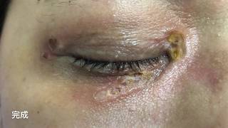 雙眼黃斑瘤CO2雷射治療 美麗新城診所莊禮謙醫師 Xanthelasma, fractional laser, Dr George