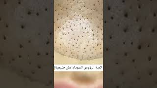 Satisfying Blackhead Removal Video - Relaxing & Soothing Skin Care
