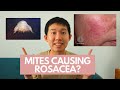 MANAGEMENT OF ROSACEA