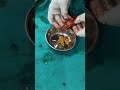 Laparoscopic Cholycystectomy Gallbladder stone removal by Dr Kishan katua