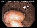 thickened fold a sign of submucosal invasion1