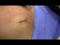 naevus mole cheek excision u0026 closure