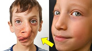 15 Unusual People Who Suffer Very Rare Conditions