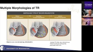 Cardiology Grand Rounds: Is Tricuspid Regurgitation Important?