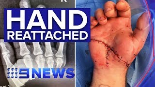 Man's severed hand reattached in rare surgery | Nine News Australia