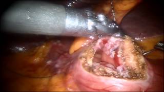 Robotic Pyloroplasty