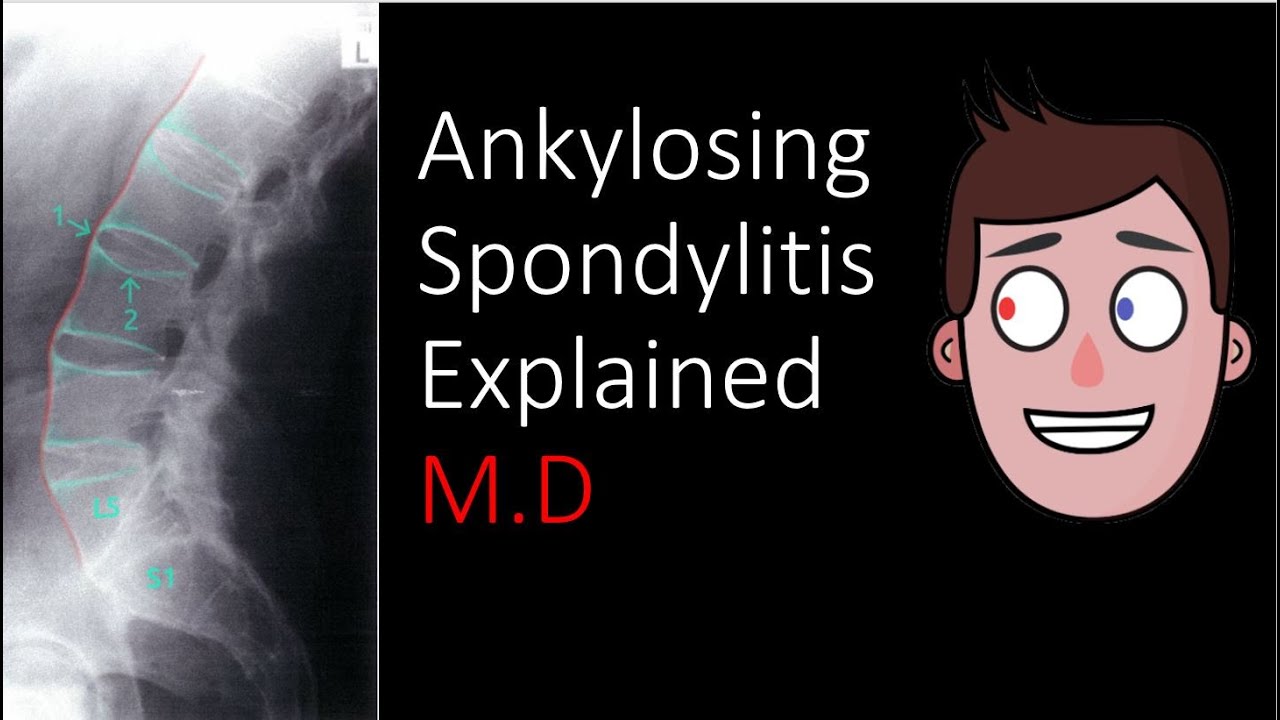 Ankylosing Spondylitis Explained Youtube