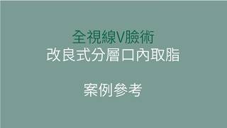 【案例】全視線V臉術 - 改良式分層口內取脂