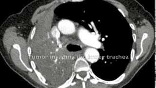 Sleeve Pneumonectomy for Lung Cancer