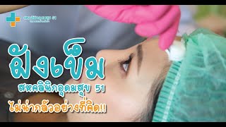 การฝังเข็ม - สหคลินิกอุดมสุข 51