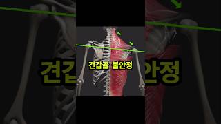 견갑골 안정성 문제로 나오는 신경증상 #견갑골통증